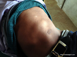হেপাটোমেগালি, Hepatomegaly